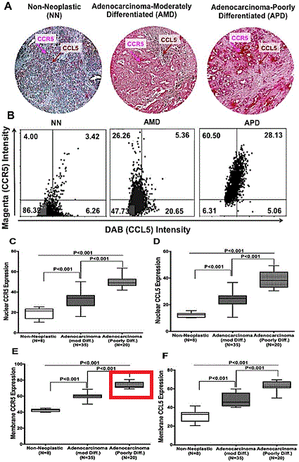 1803981285_CCR5-and-CCL5-expression-in-pancreatic-cancer-tissues-A-Pancreatic-tissues-from.gif